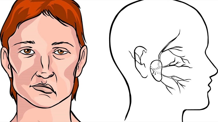 Biến chứng của sỏi tuyến nước bọt nước bọt mang tai có thể gây liệt mặt